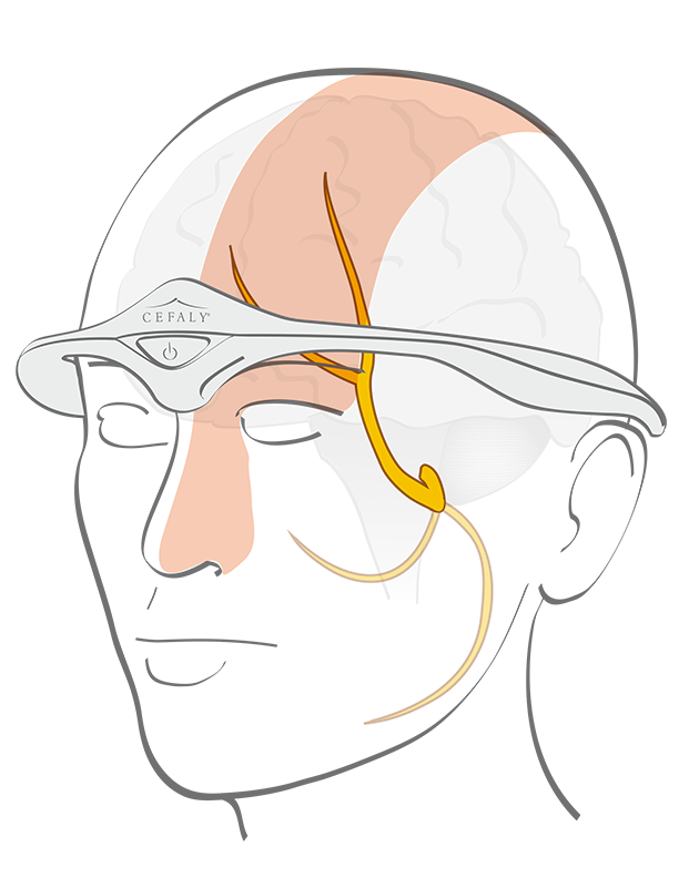 Treatment and prevention of miraine: Cefaly